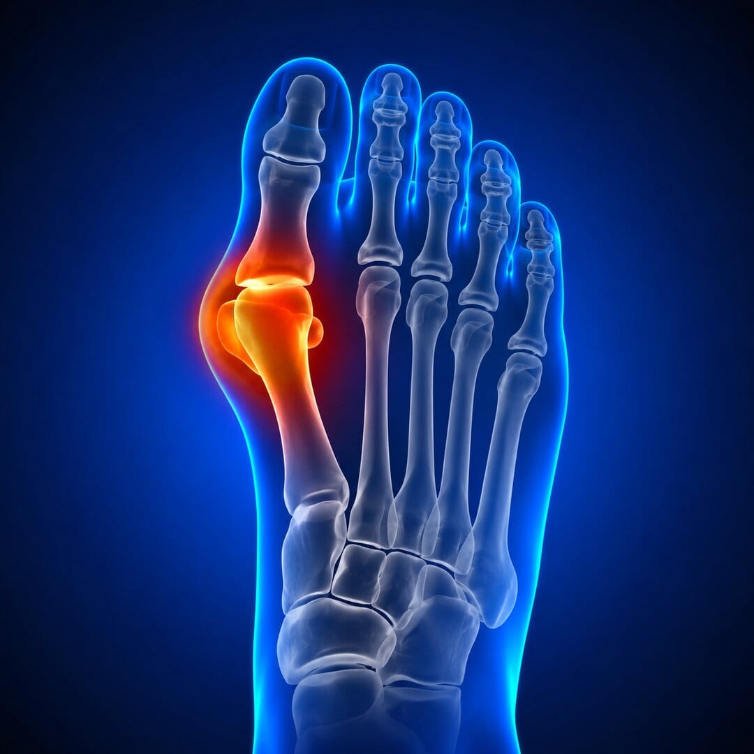 Bunion