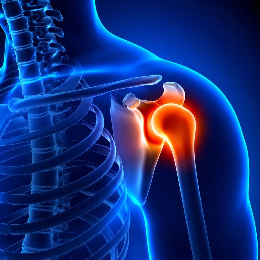 Frozen shoulder